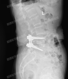 顺德和平外科医院：微创技术为75岁老人解除腰腿痛困扰